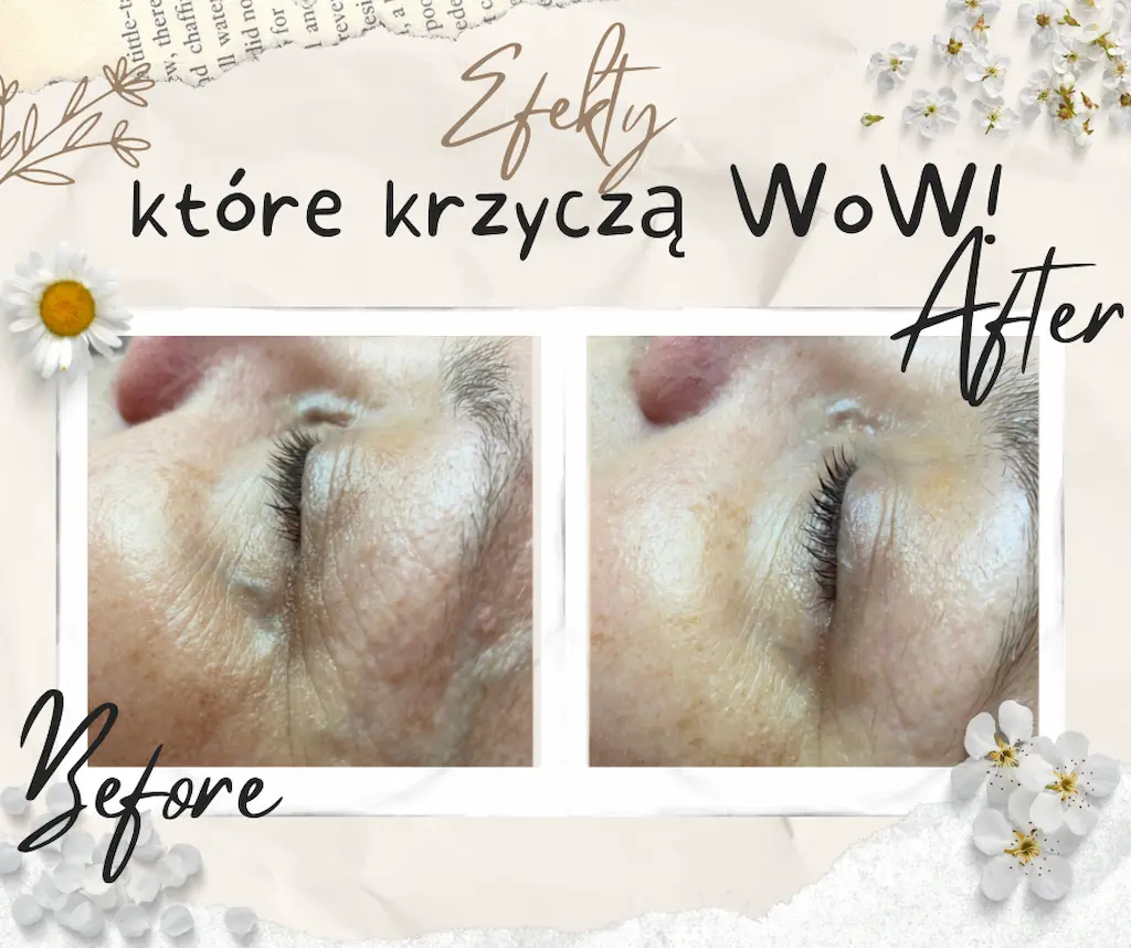 Efekt zabiegu — skóra przed i po terapii