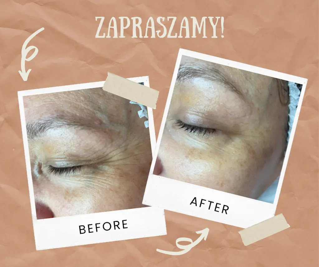 DermaOrganic™ Active Treatment — efekt zabiegu przed i po