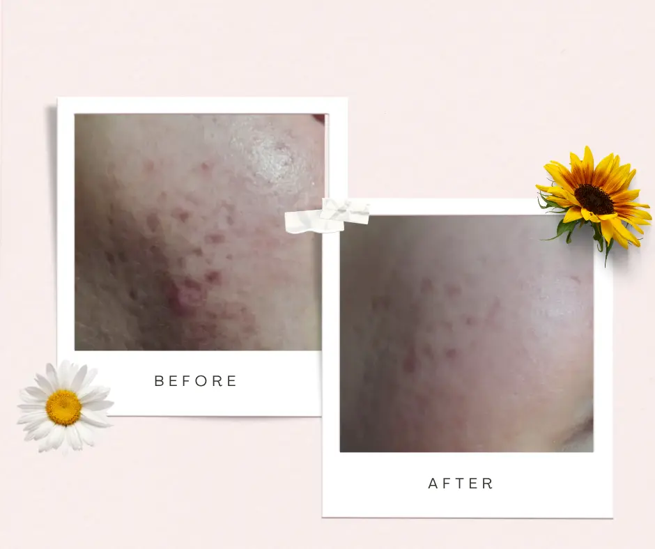 Terapia NOON Aesthetics — porównanie skóry przed i po serii zabiegów