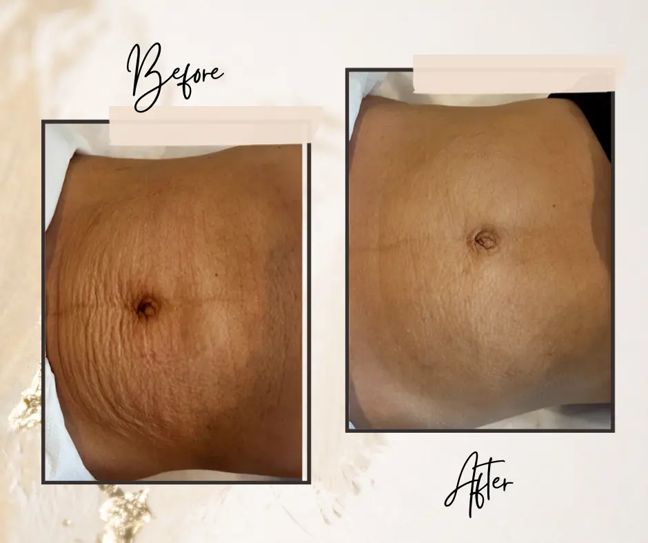 DermaOrganic™ Active Treatment — skóra przed i po terapii (1)